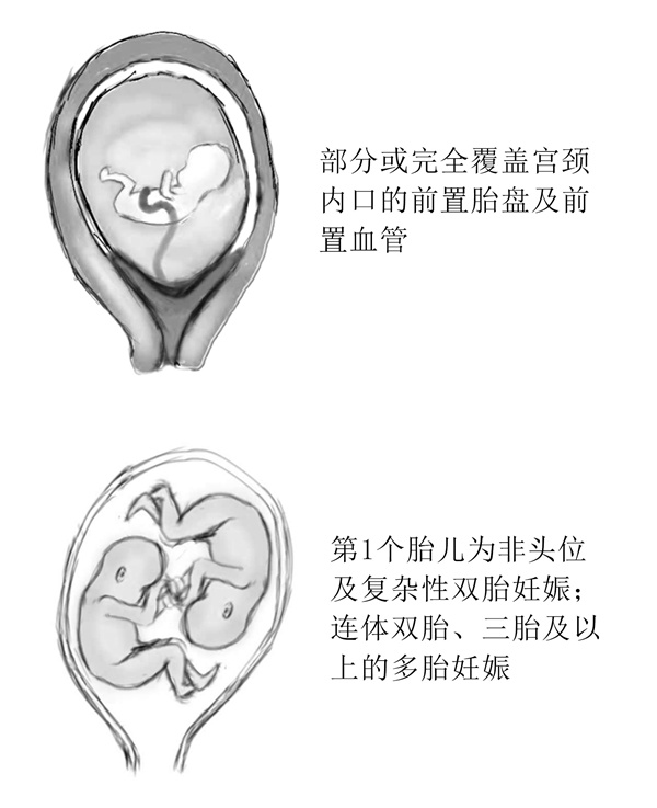 刨宫产(1)_10.jpg