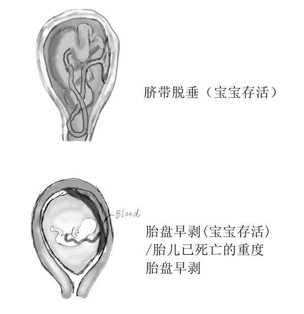 刨宫产(1)_11.jpg