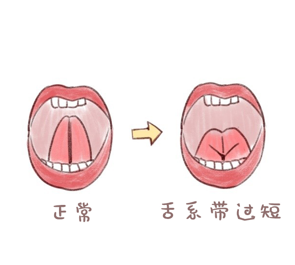 孩子说话不灵活，可能是舌系带过短惹的祸！