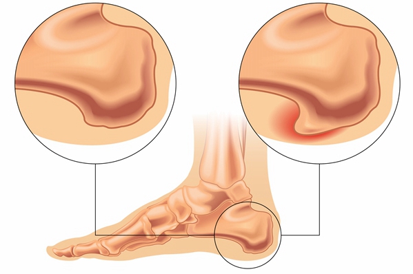 贴膏药 扎针灸 吃止痛药能消除骨刺吗